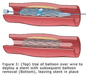 Peripheral Angioplasty / Stent