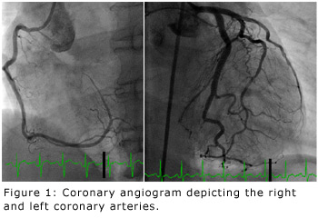 Figure 1: Coronary angiogram depicting the right and left coronary arteries.